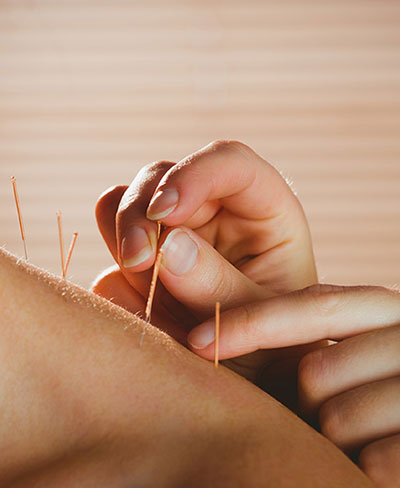 photo of acupuncture treatment
